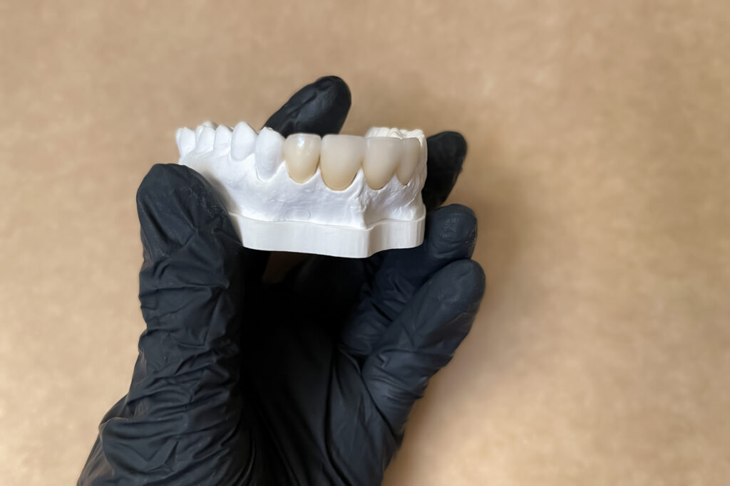 Modèle en plâtre avec dents en céramique tenues par un dentiste en gant noir.